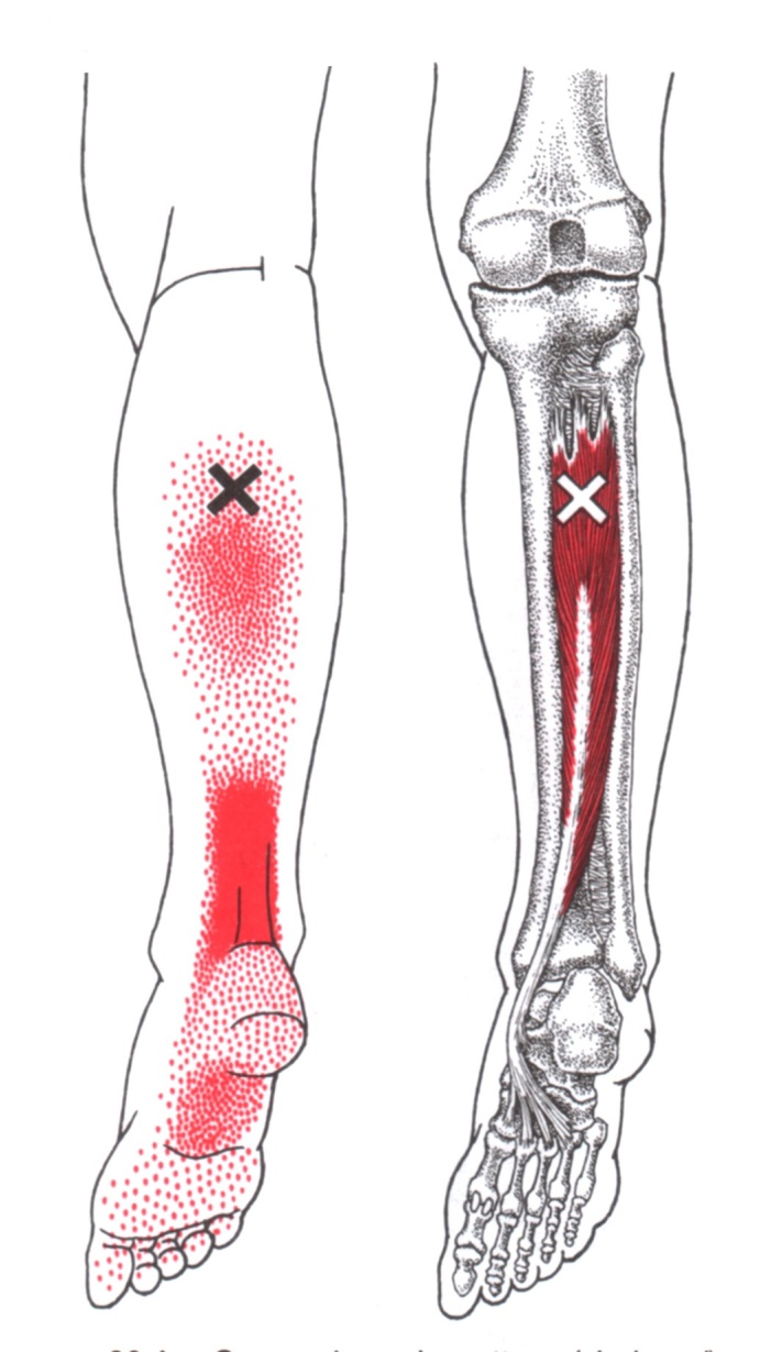 Tibialis Posterior | The Trigger Point & Referred Pain Guide